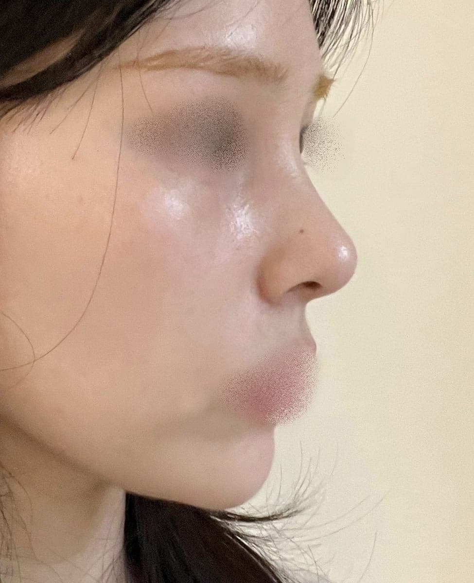 Ujung tebal dibuat tipis dengan tulang rawan donor + osteotomi