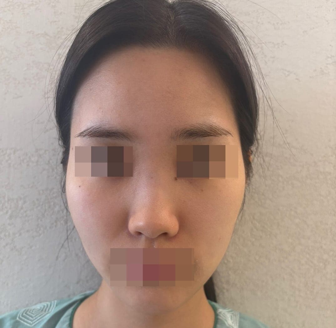 Crooked nose correction, tip with donor cartilage