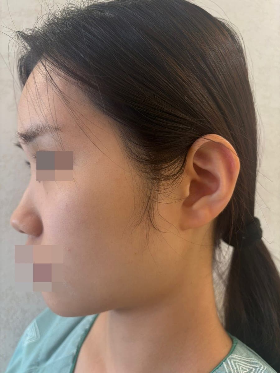Crooked nose correction, tip with donor cartilage