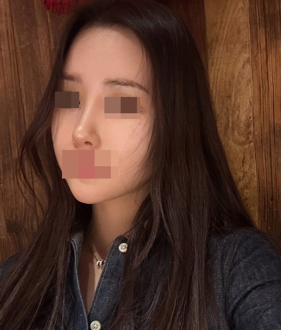 Crooked nose correction, tip with donor cartilage