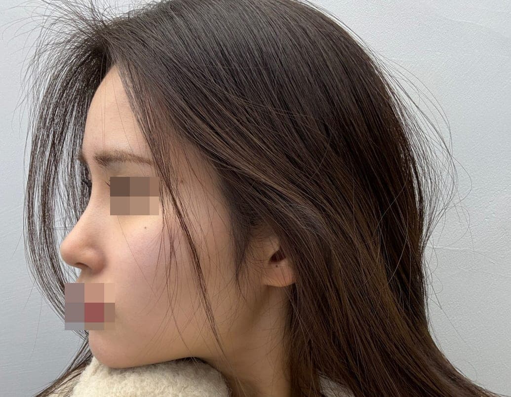 Crooked nose correction, tip with donor cartilage