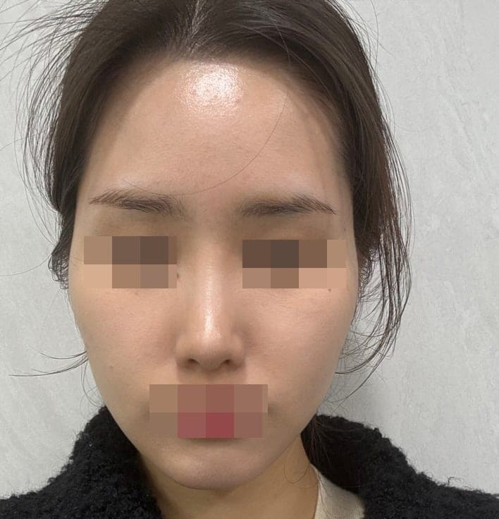 Crooked nose correction, tip with donor cartilage