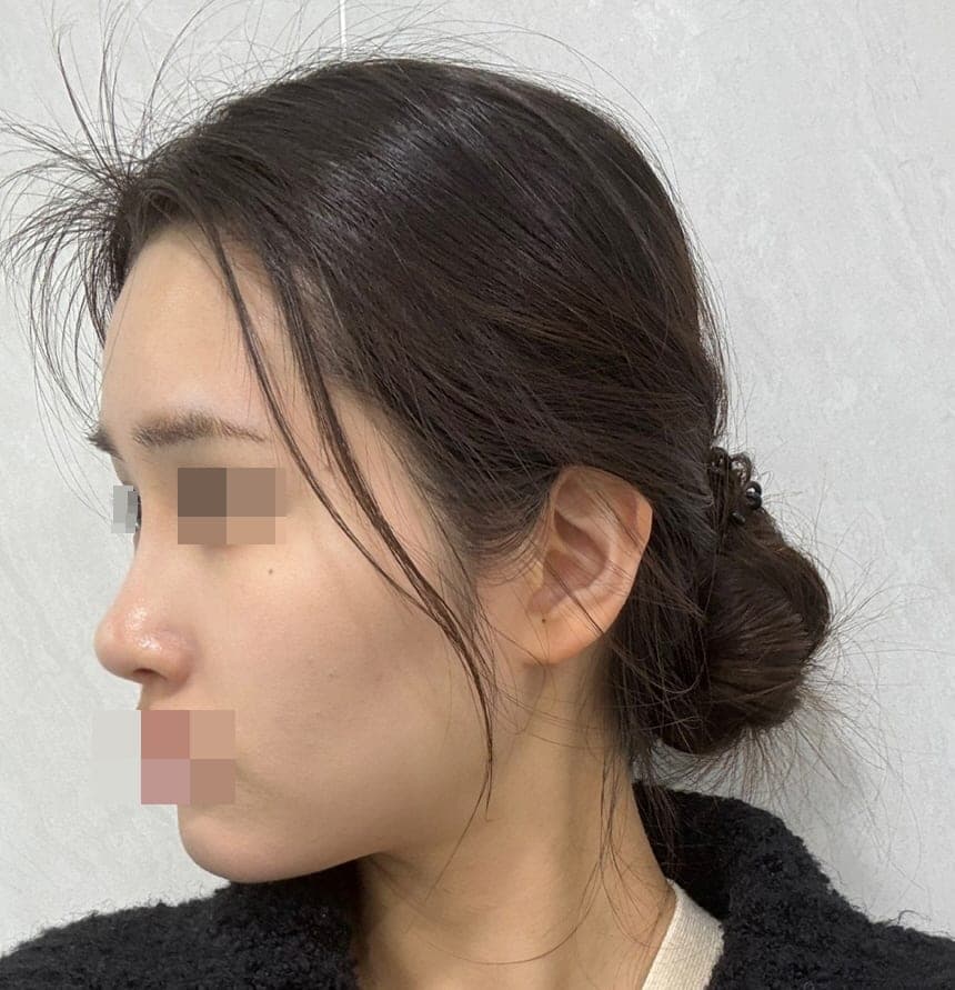 Crooked nose correction, tip with donor cartilage