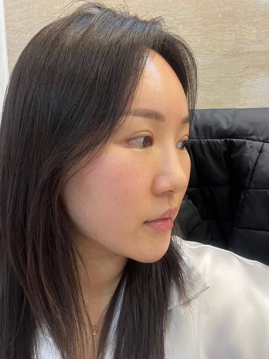 Tip plasty with own cartilage
