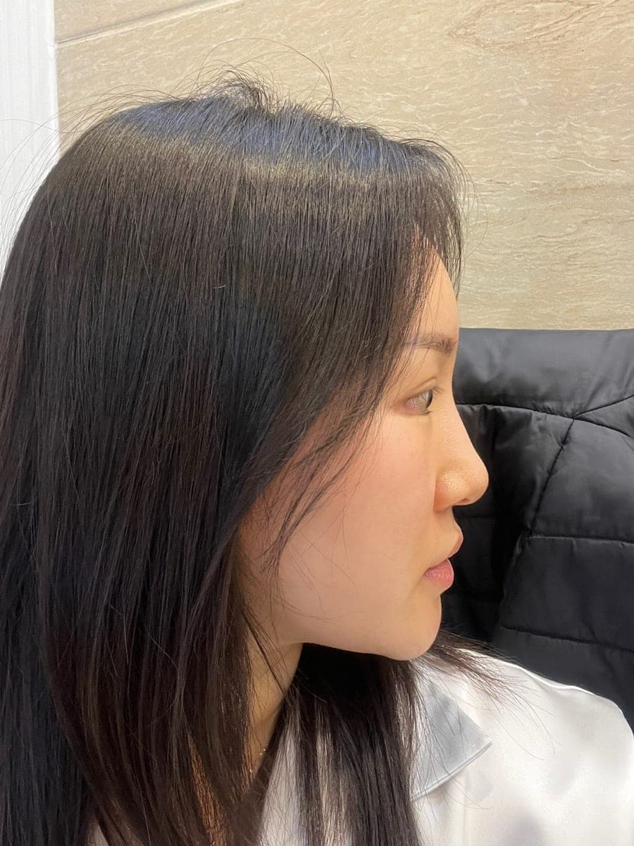 Tip plasty with own cartilage