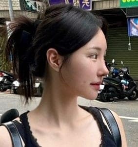 Tip plasty with own cartilage