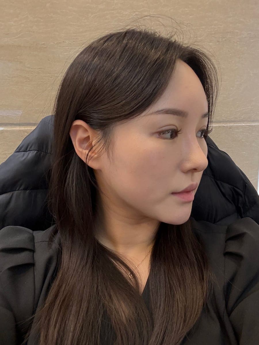 Tip plasty with own cartilage