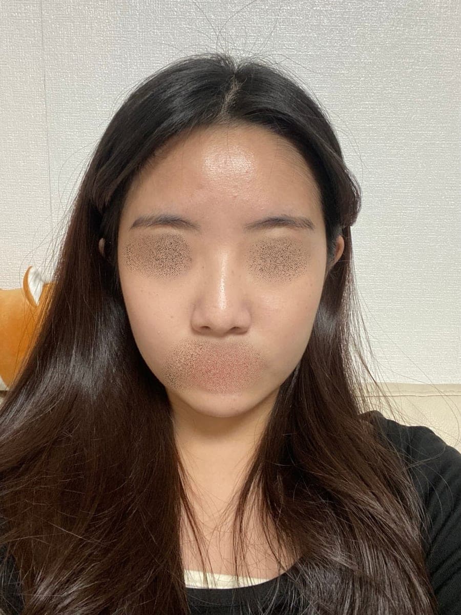 Garis batang hidung lebih lurus, ujung dengan tulang rawan sendiri + osteotomi