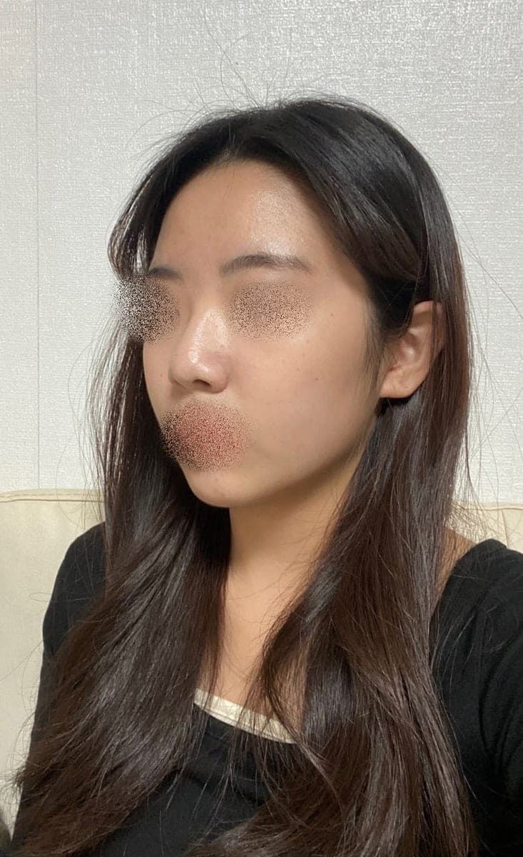 Garis batang hidung lebih lurus, ujung dengan tulang rawan sendiri + osteotomi