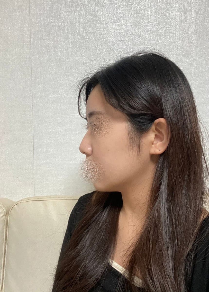 Garis batang hidung lebih lurus, ujung dengan tulang rawan sendiri + osteotomi