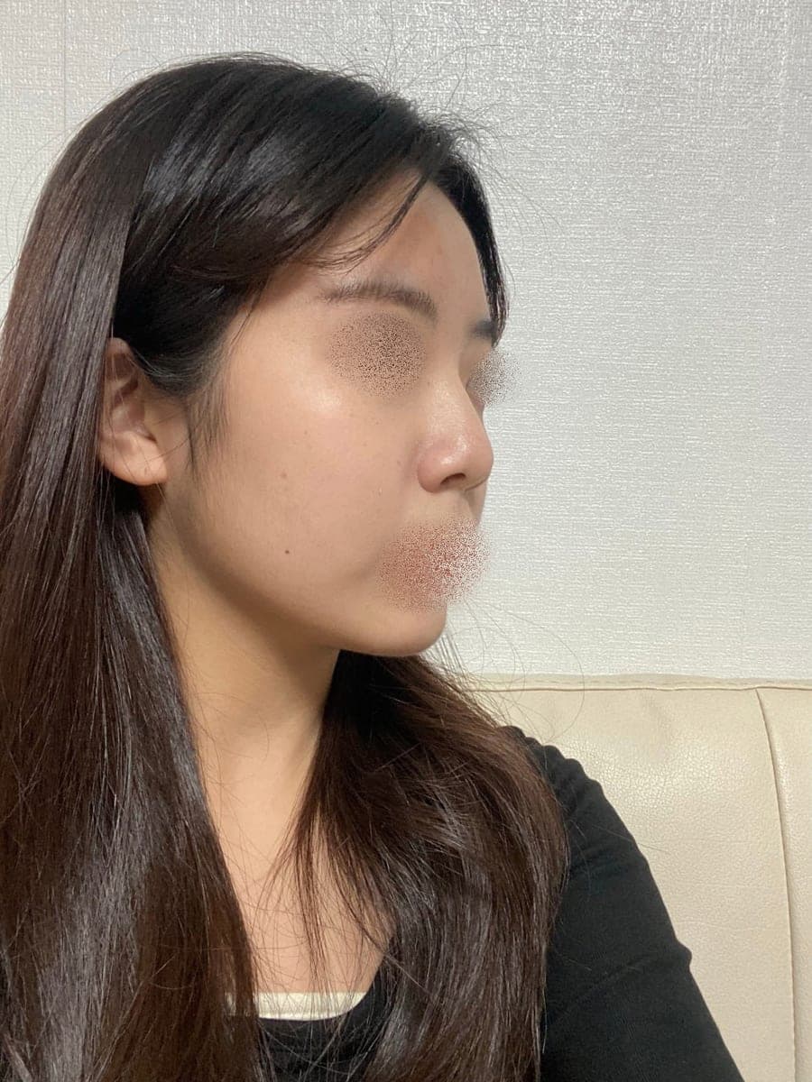 Garis batang hidung lebih lurus, ujung dengan tulang rawan sendiri + osteotomi