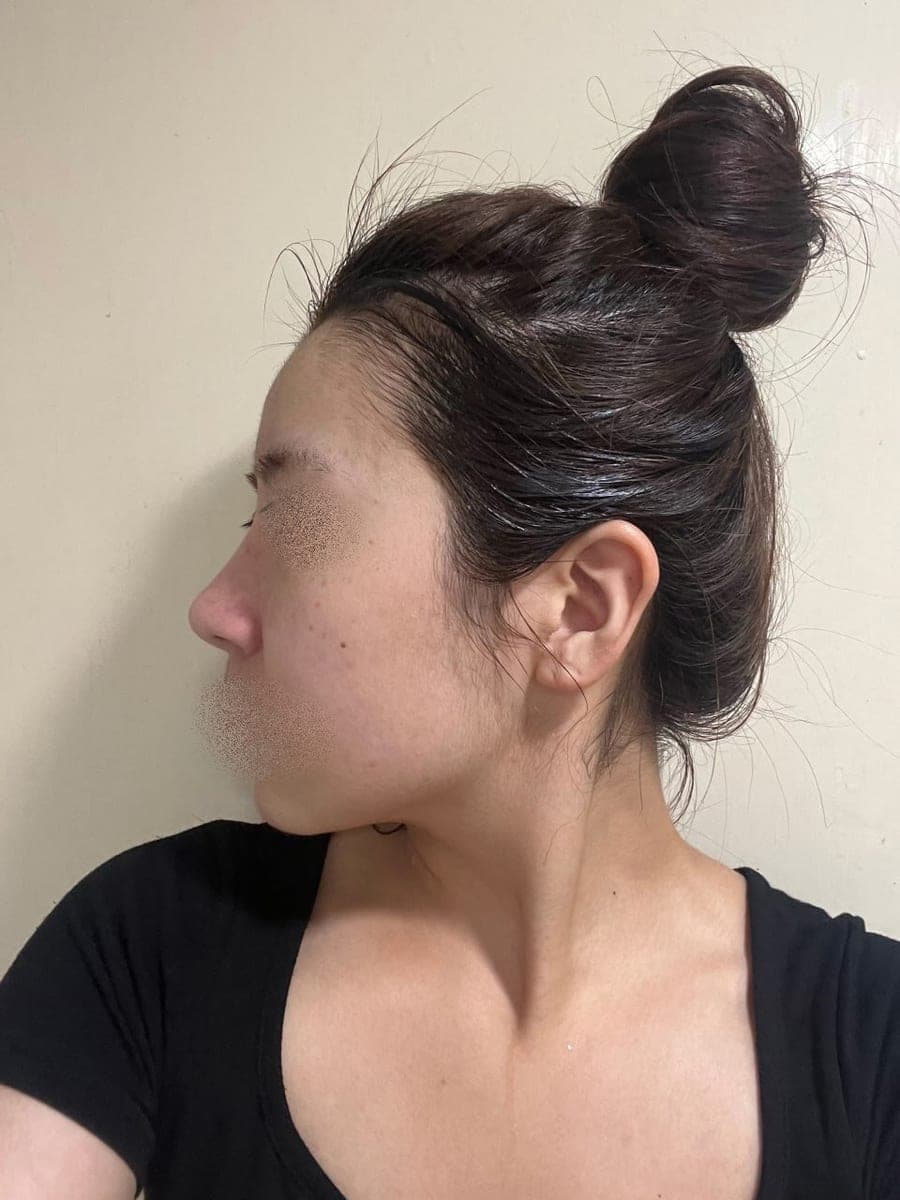 Garis batang hidung lebih lurus, ujung dengan tulang rawan sendiri + osteotomi