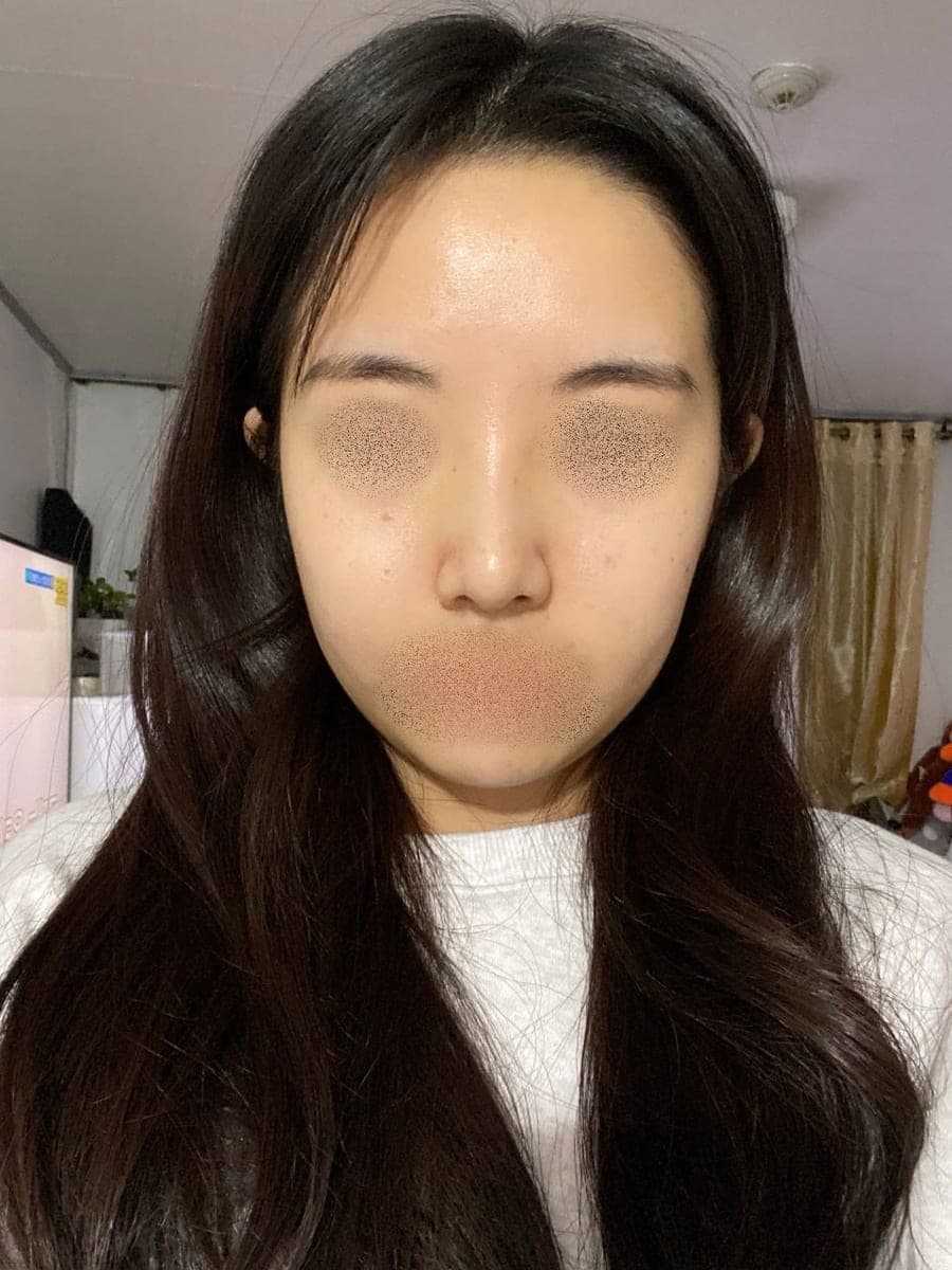 Garis batang hidung lebih lurus, ujung dengan tulang rawan sendiri + osteotomi