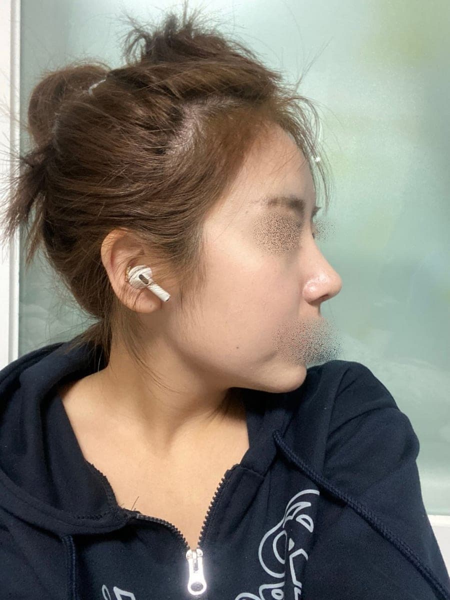 Garis batang hidung lebih lurus, ujung dengan tulang rawan sendiri + osteotomi
