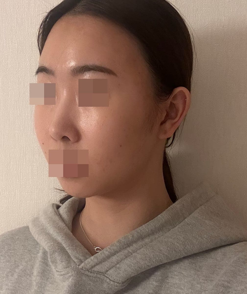 Tip only, with own cartilage