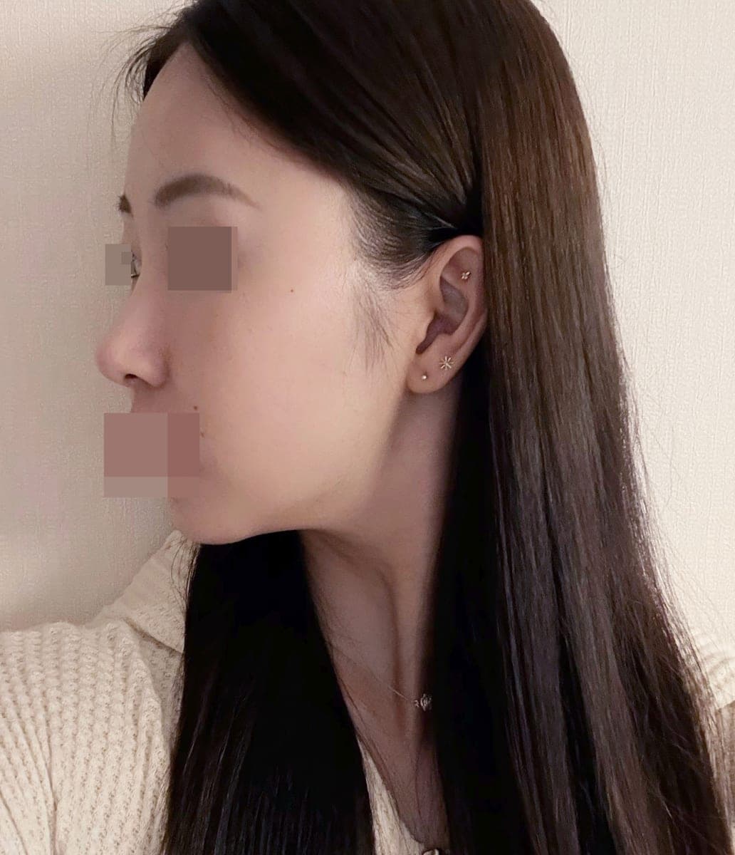 Tip only, with own cartilage