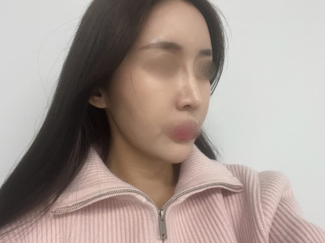 ถอดซิลิโคนแล้วสร้างใหม่ด้วยกระดูกอ่อนตัวเอง