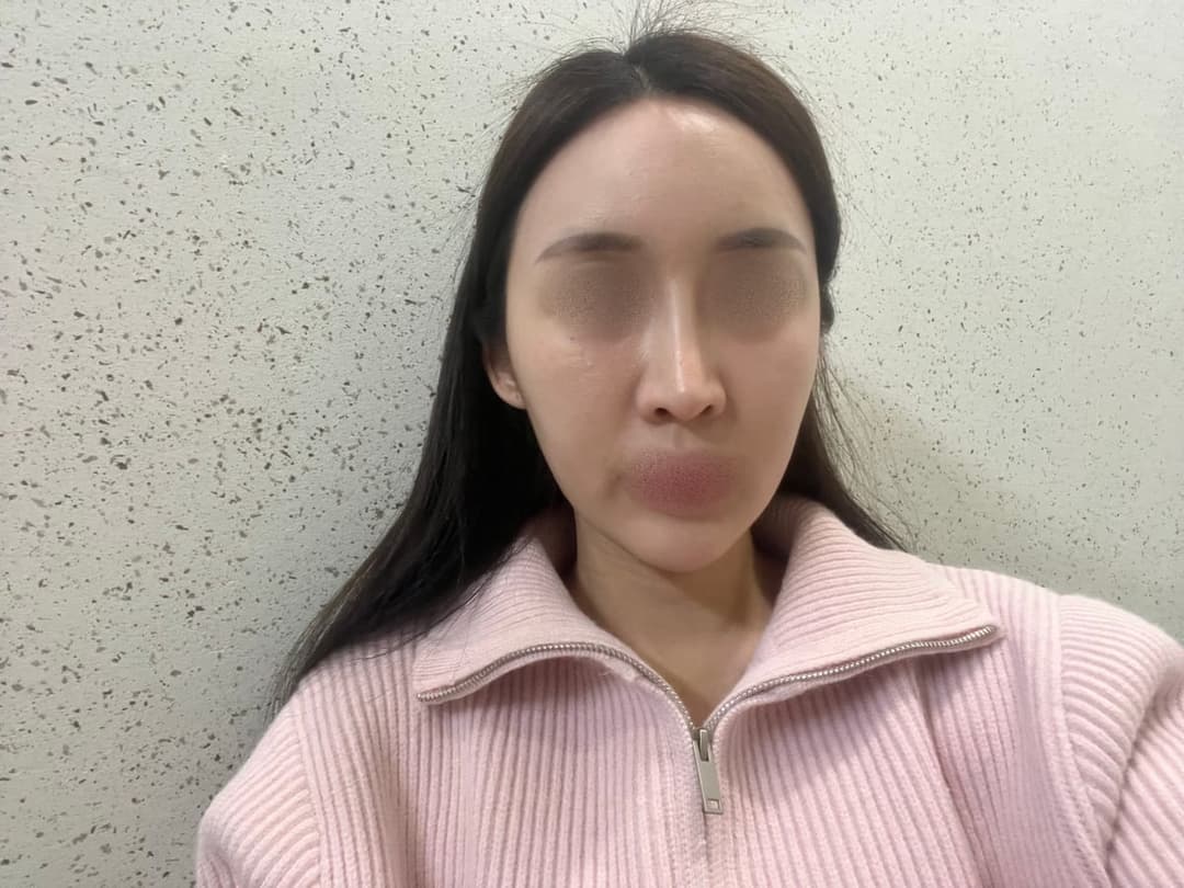 ถอดซิลิโคนแล้วสร้างใหม่ด้วยกระดูกอ่อนตัวเอง
