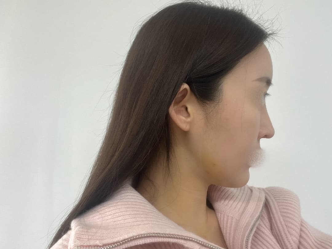 ถอดซิลิโคนแล้วสร้างใหม่ด้วยกระดูกอ่อนตัวเอง