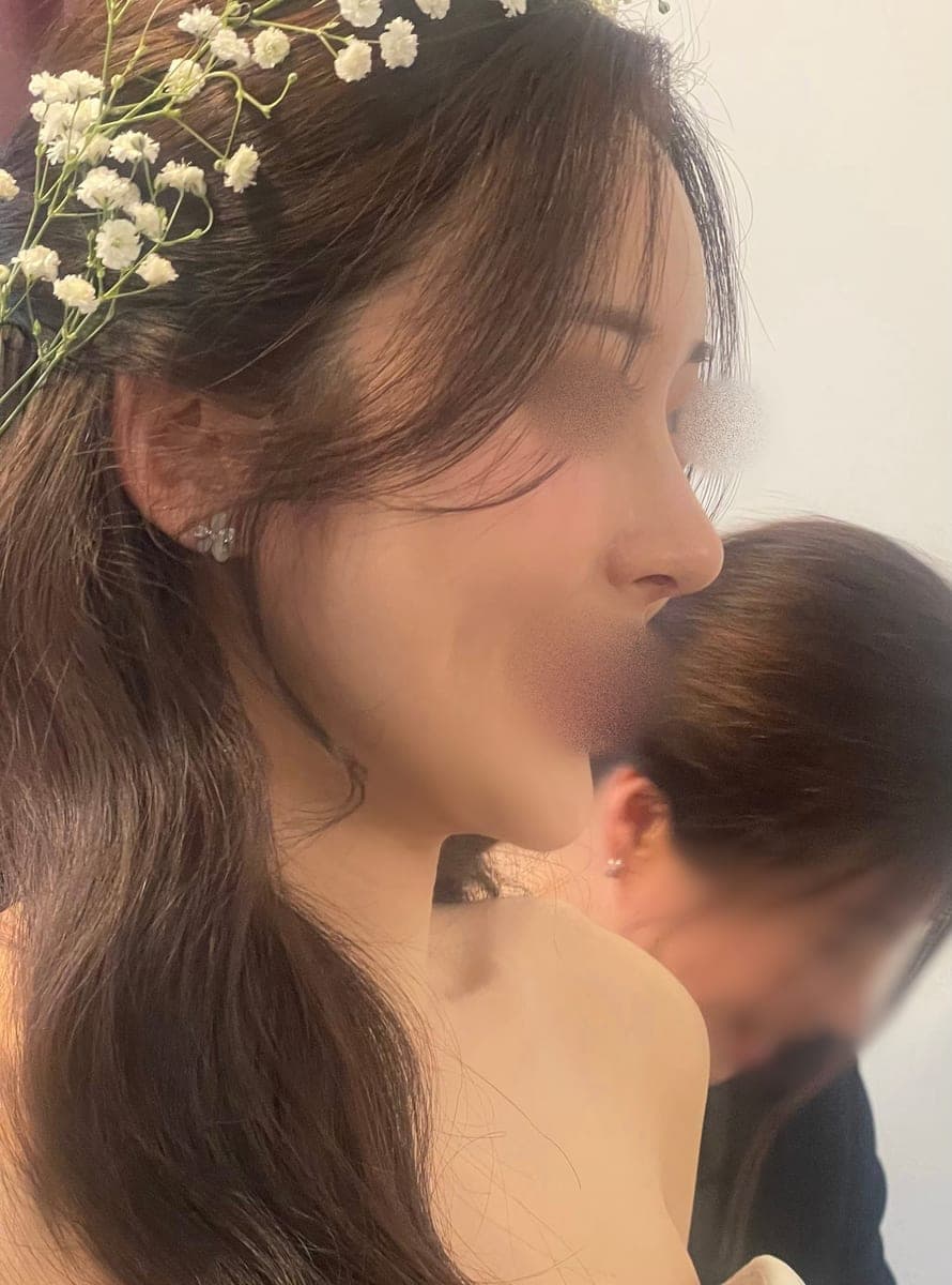 ถอดซิลิโคนแล้วสร้างใหม่ด้วยกระดูกอ่อนตัวเอง