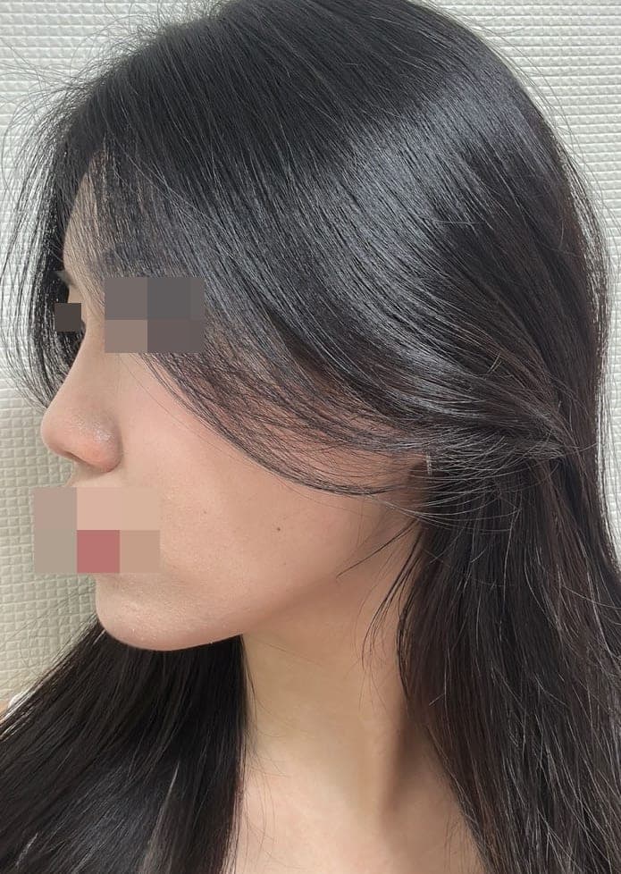 Building the tip with own cartilage
