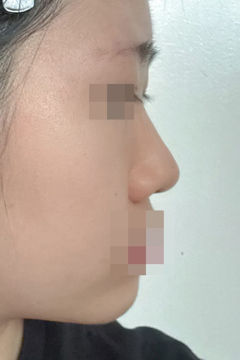 Kasus koreksi hidung bulbous