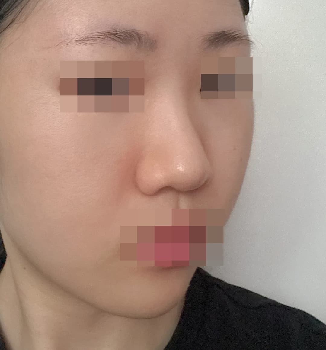 Kasus koreksi hidung bulbous