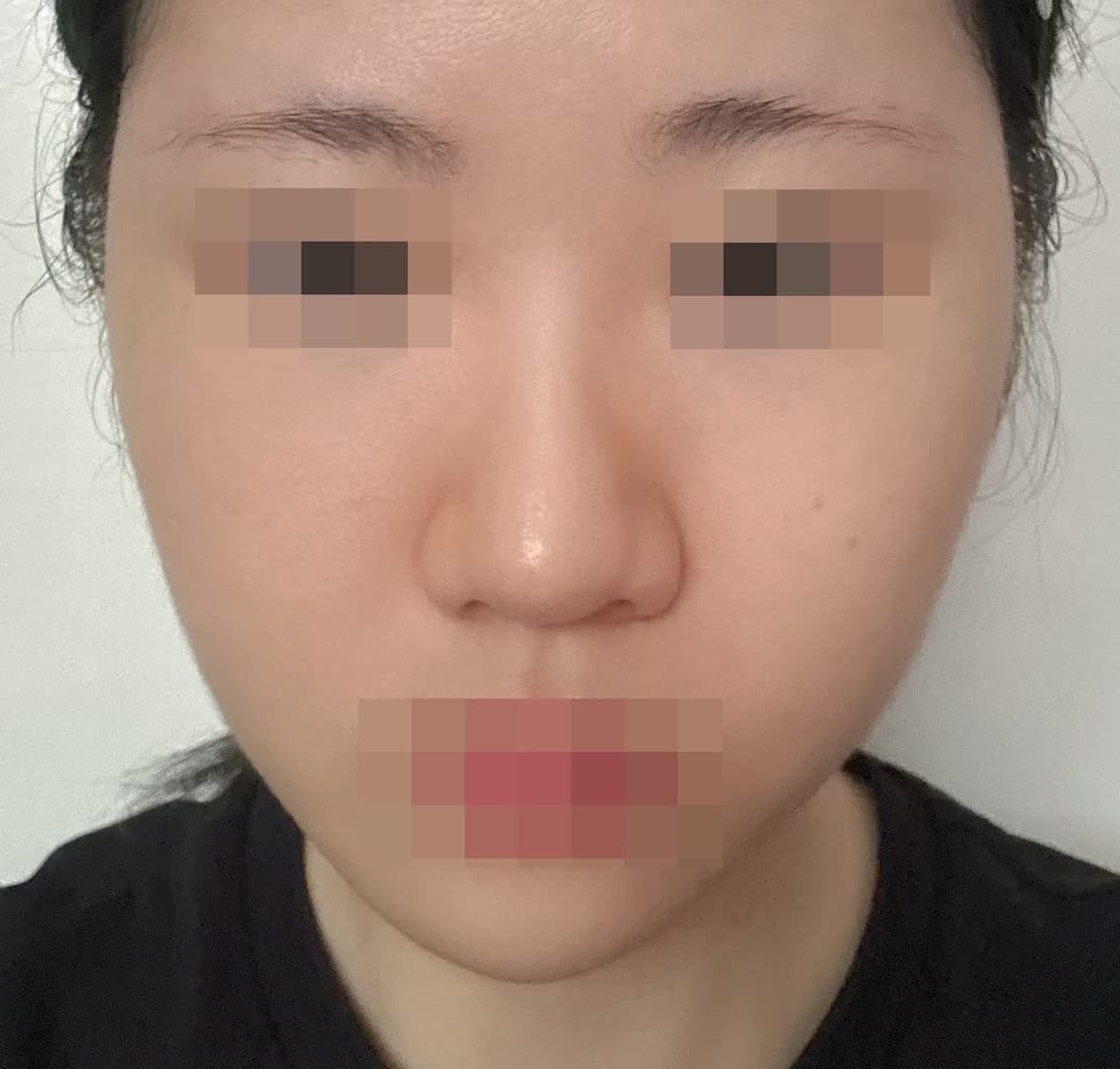 Kasus koreksi hidung bulbous