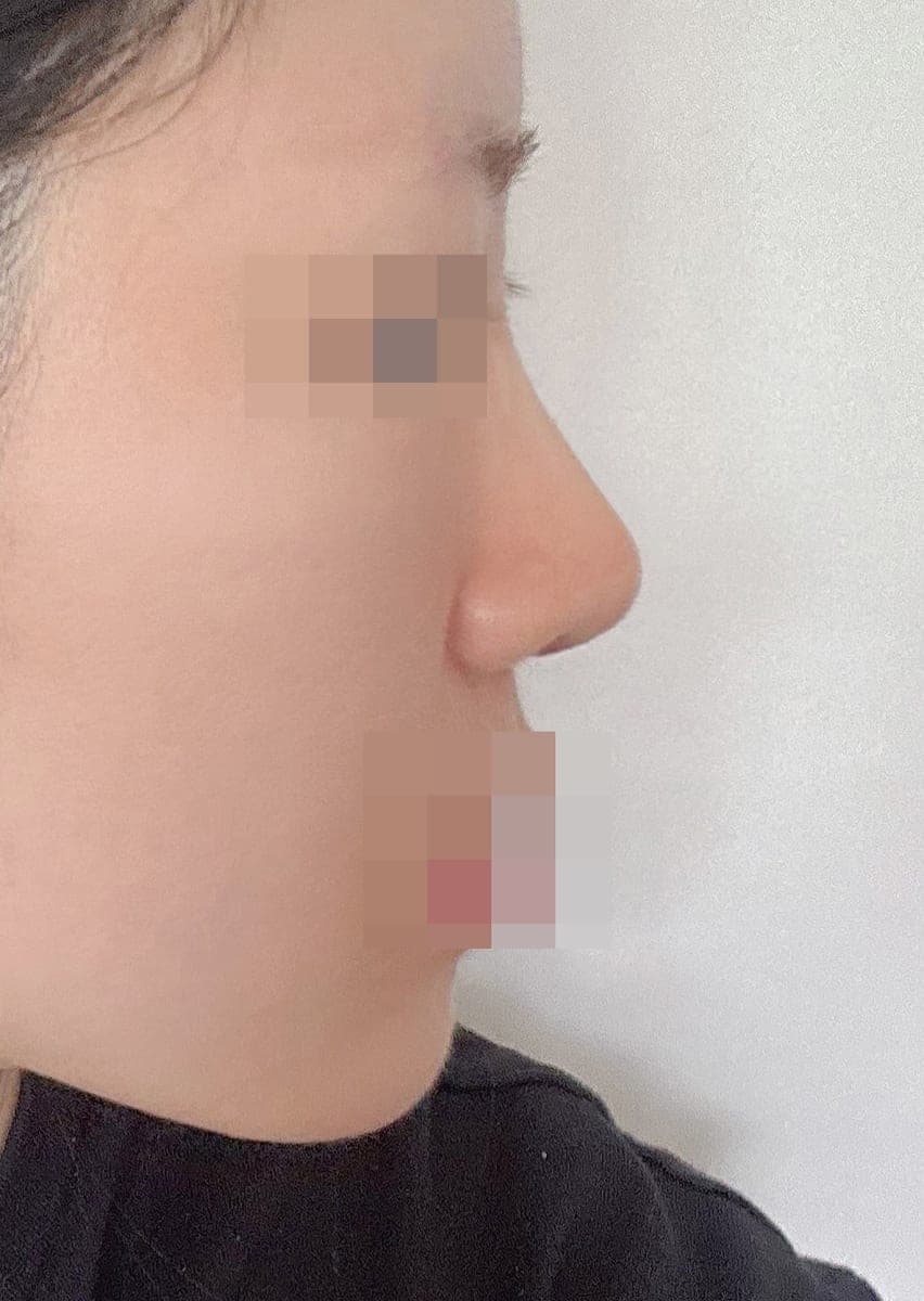 Kasus koreksi hidung bulbous