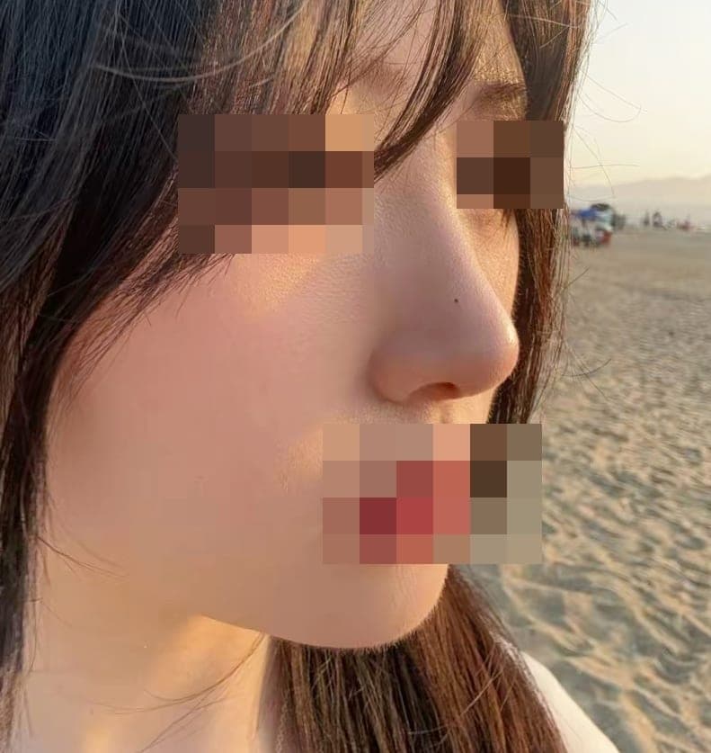 Kasus koreksi hidung bulbous