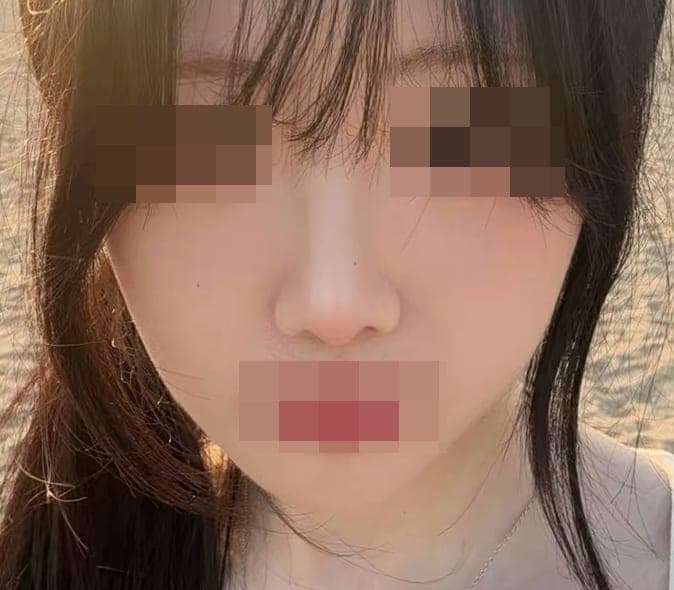 Kasus koreksi hidung bulbous