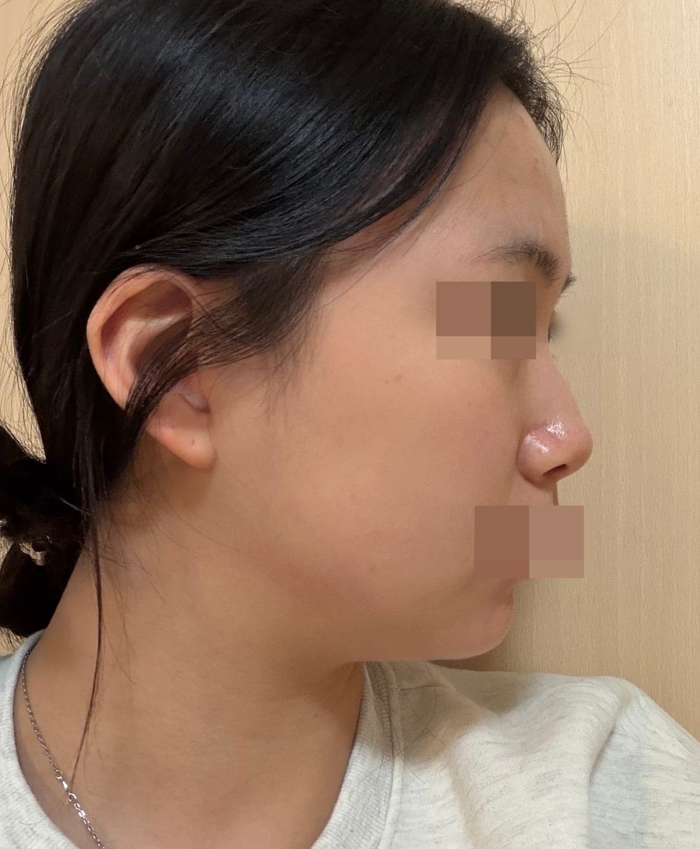 Hanya ujung hidung, dengan tulang rawan sendiri