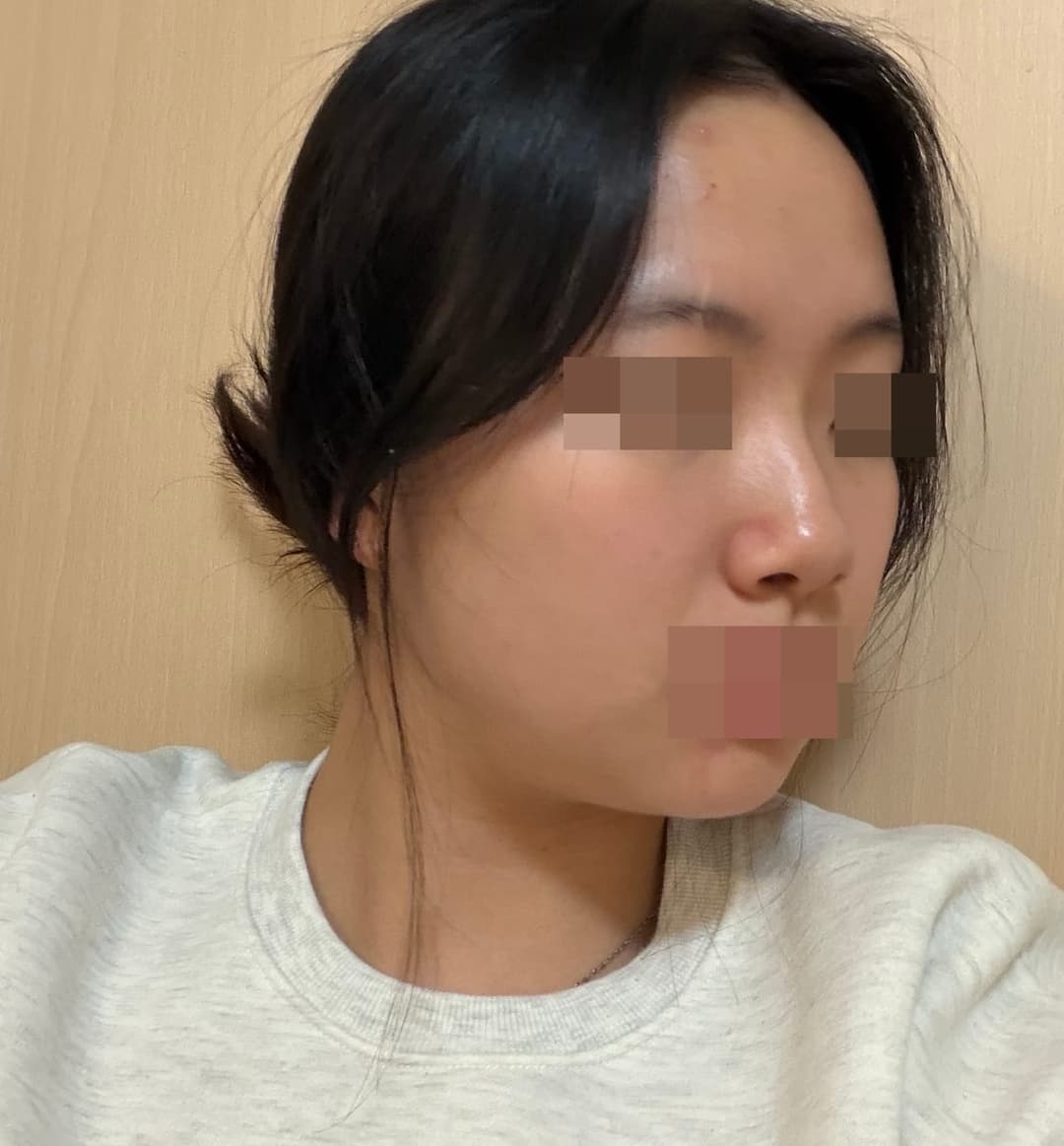 Hanya ujung hidung, dengan tulang rawan sendiri