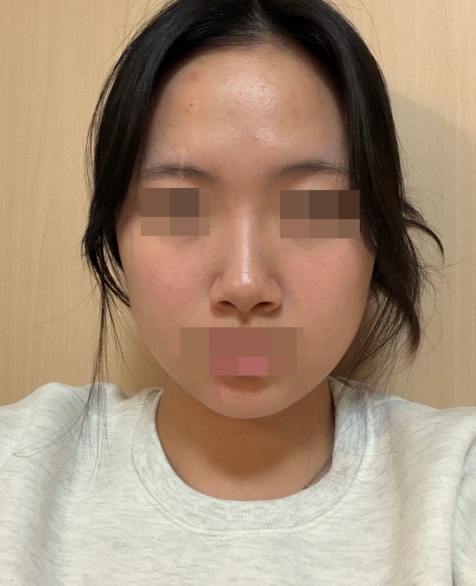 Hanya ujung hidung, dengan tulang rawan sendiri