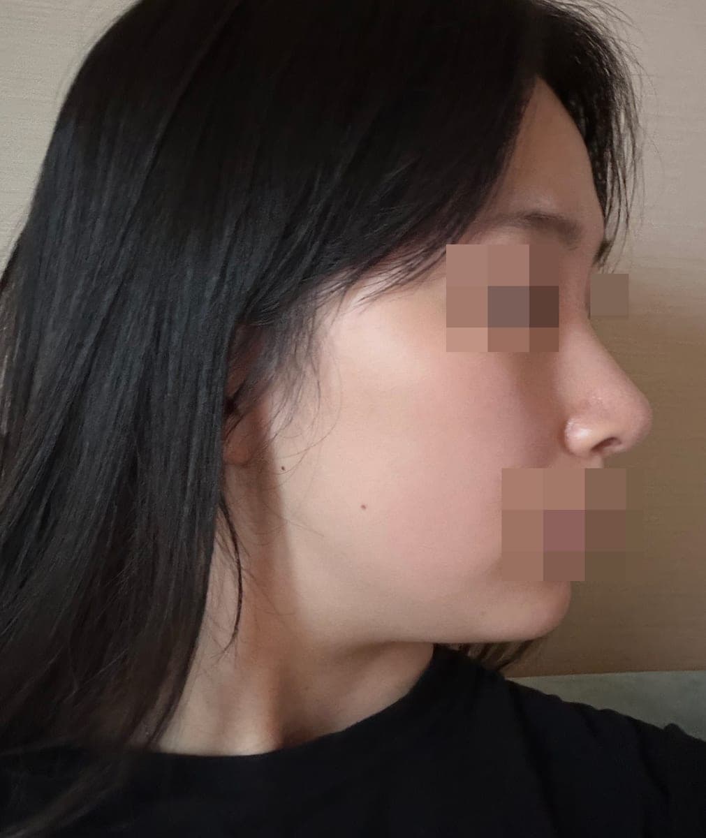 Hanya ujung hidung, dengan tulang rawan sendiri