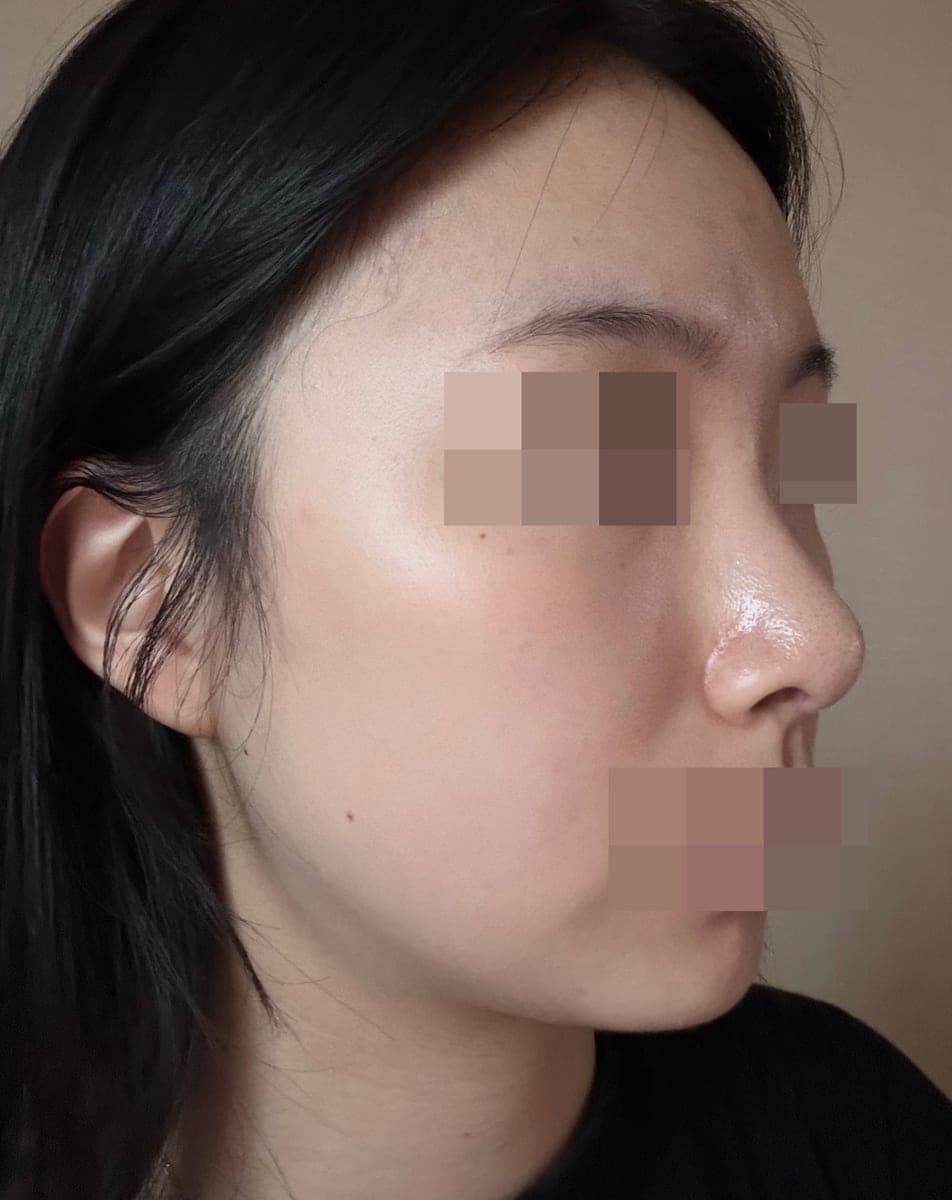 Hanya ujung hidung, dengan tulang rawan sendiri