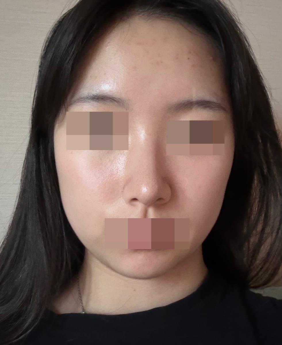 Hanya ujung hidung, dengan tulang rawan sendiri