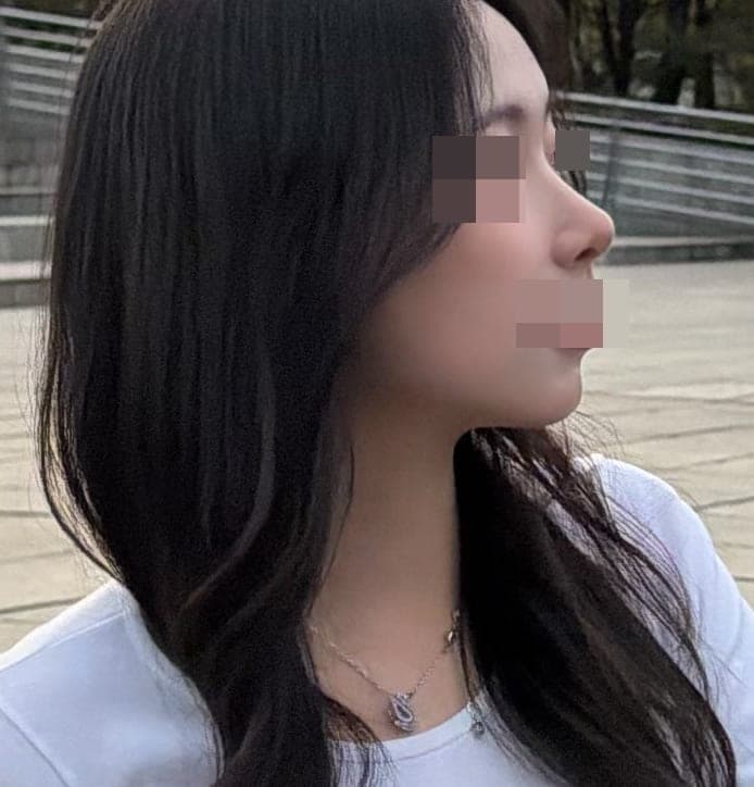 Hanya ujung hidung, dengan tulang rawan sendiri