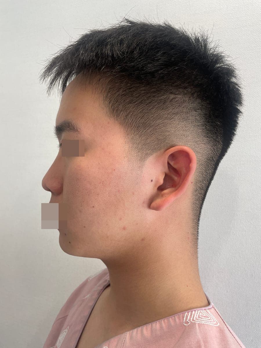 Kasus ujung bulbous dan ujung hidung sekaligus