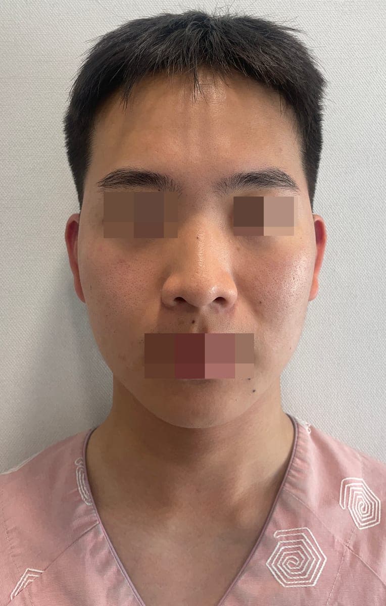Kasus ujung bulbous dan ujung hidung sekaligus