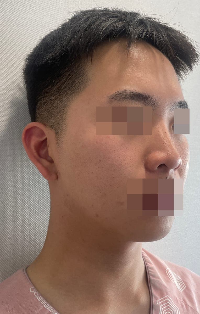 Kasus ujung bulbous dan ujung hidung sekaligus