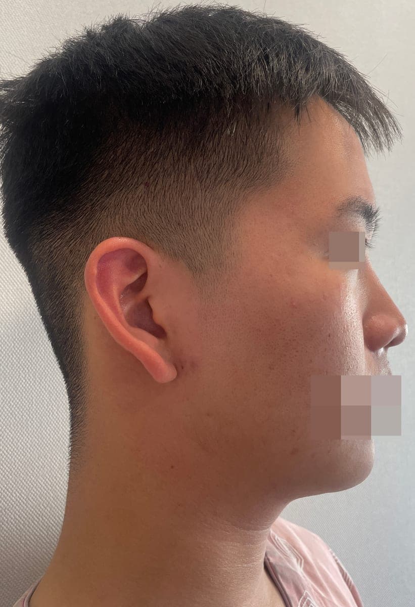 Kasus ujung bulbous dan ujung hidung sekaligus