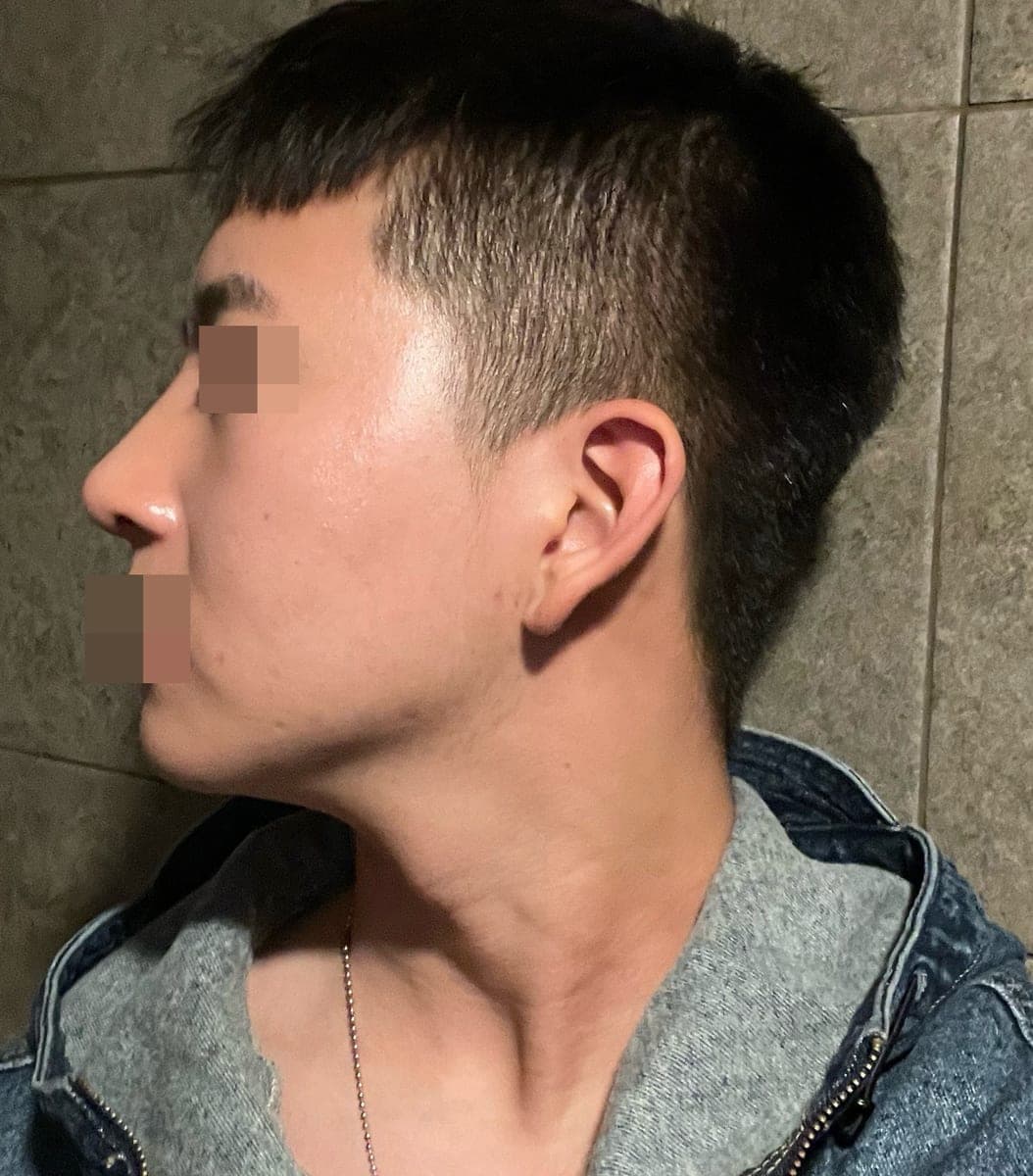 Kasus ujung bulbous dan ujung hidung sekaligus
