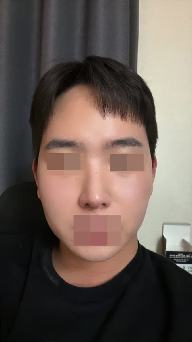 Kasus ujung bulbous dan ujung hidung sekaligus