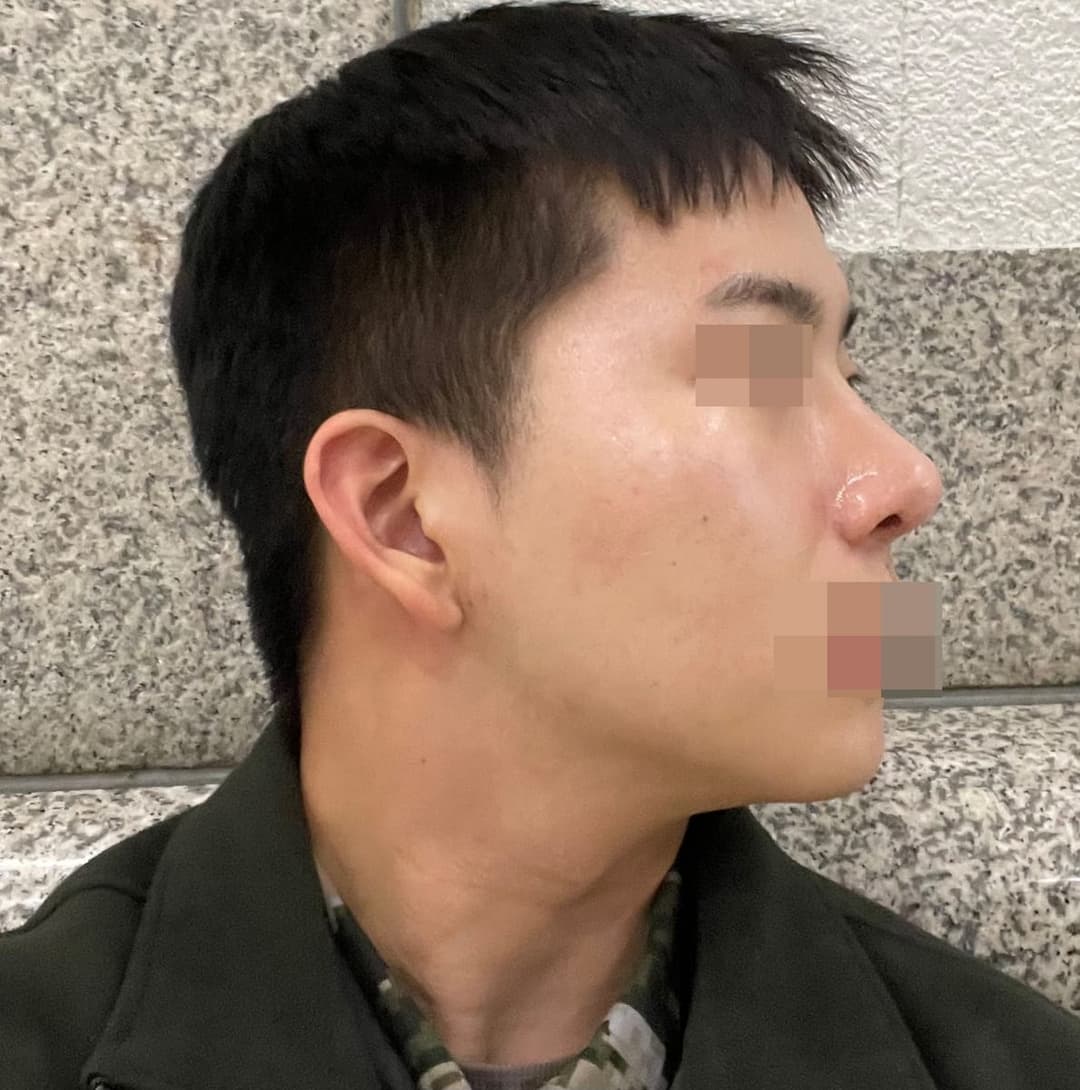 Kasus ujung bulbous dan ujung hidung sekaligus