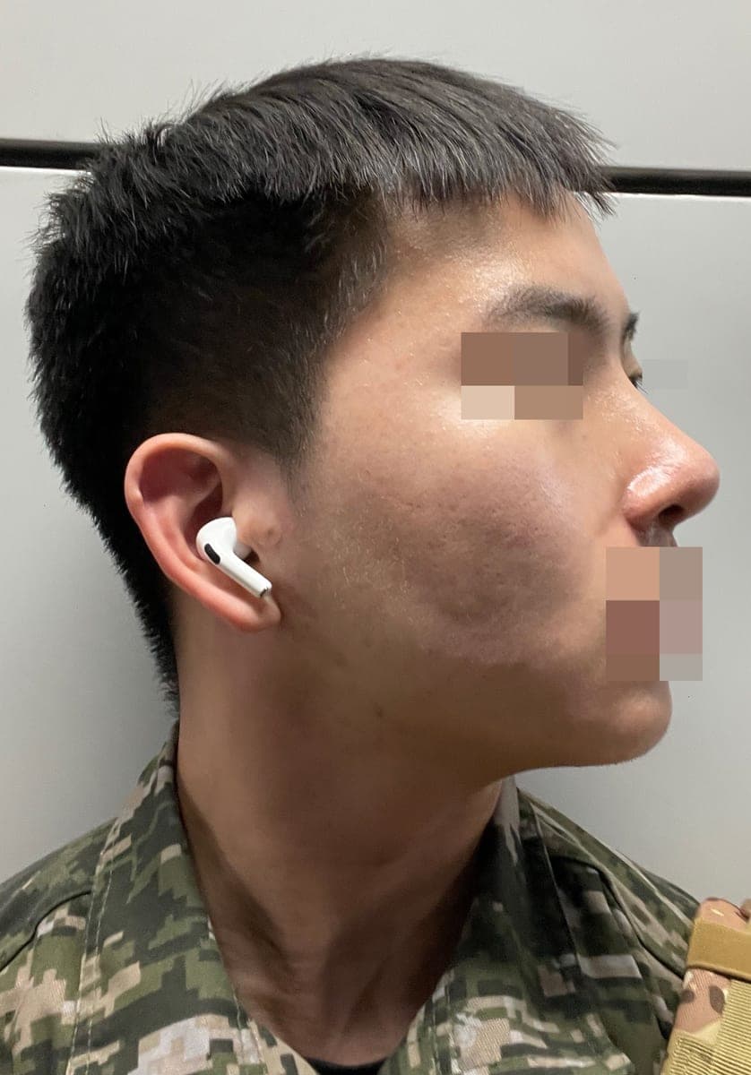 Kasus ujung bulbous dan ujung hidung sekaligus
