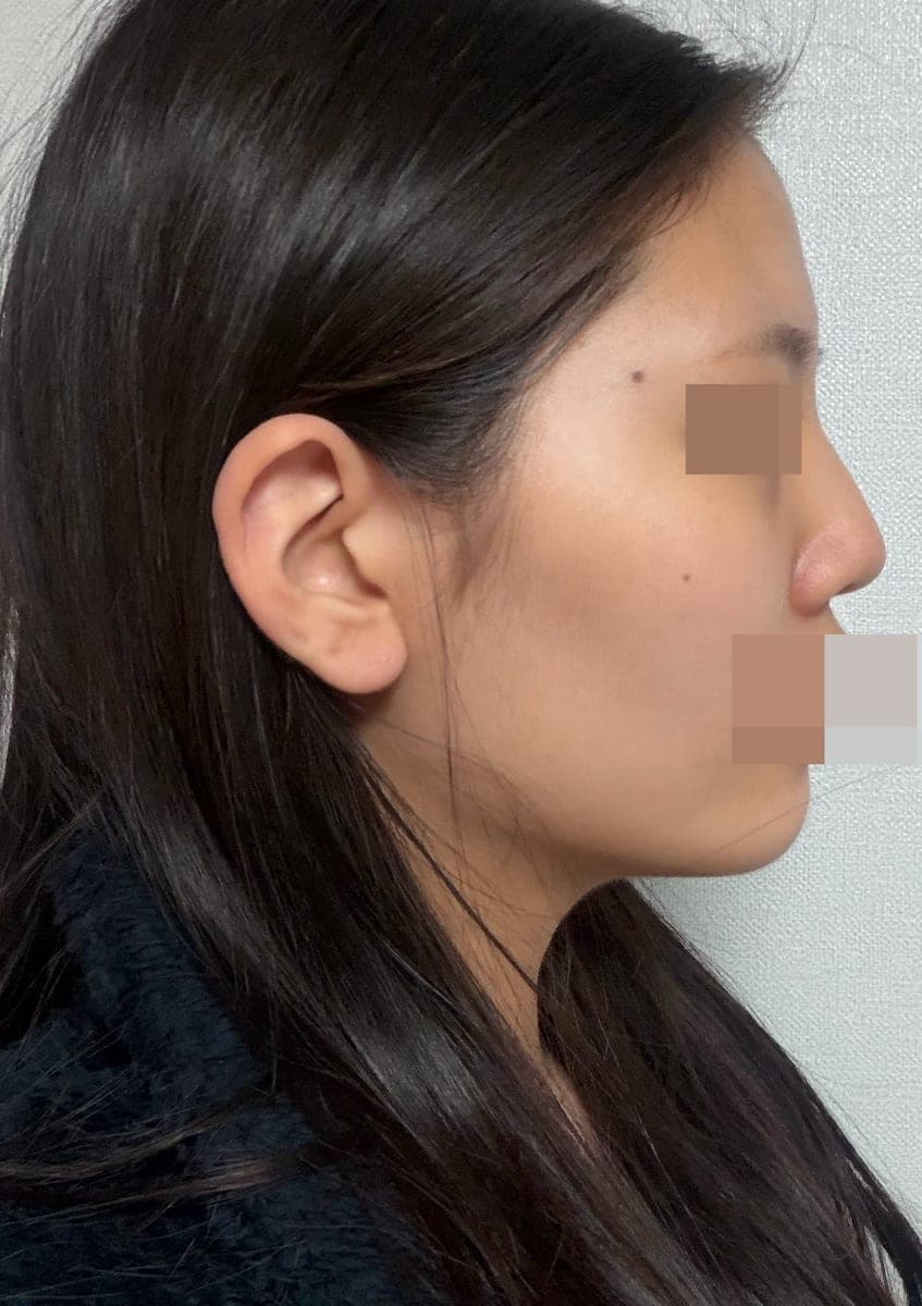 Tip plasty dengan tulang rawan sendiri