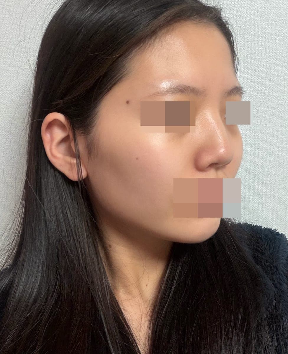 Tip plasty dengan tulang rawan sendiri