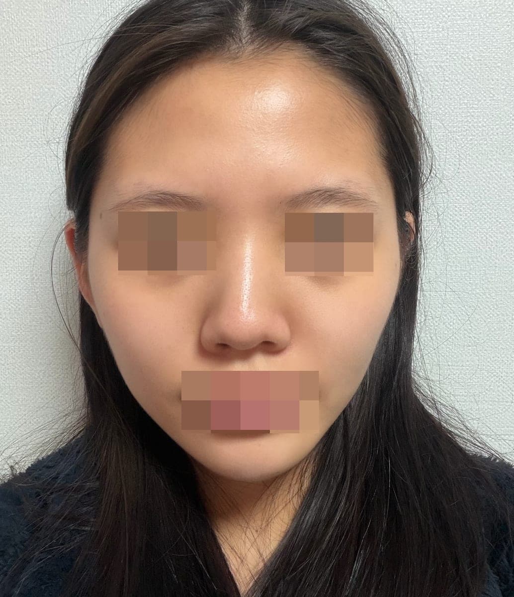Tip plasty dengan tulang rawan sendiri