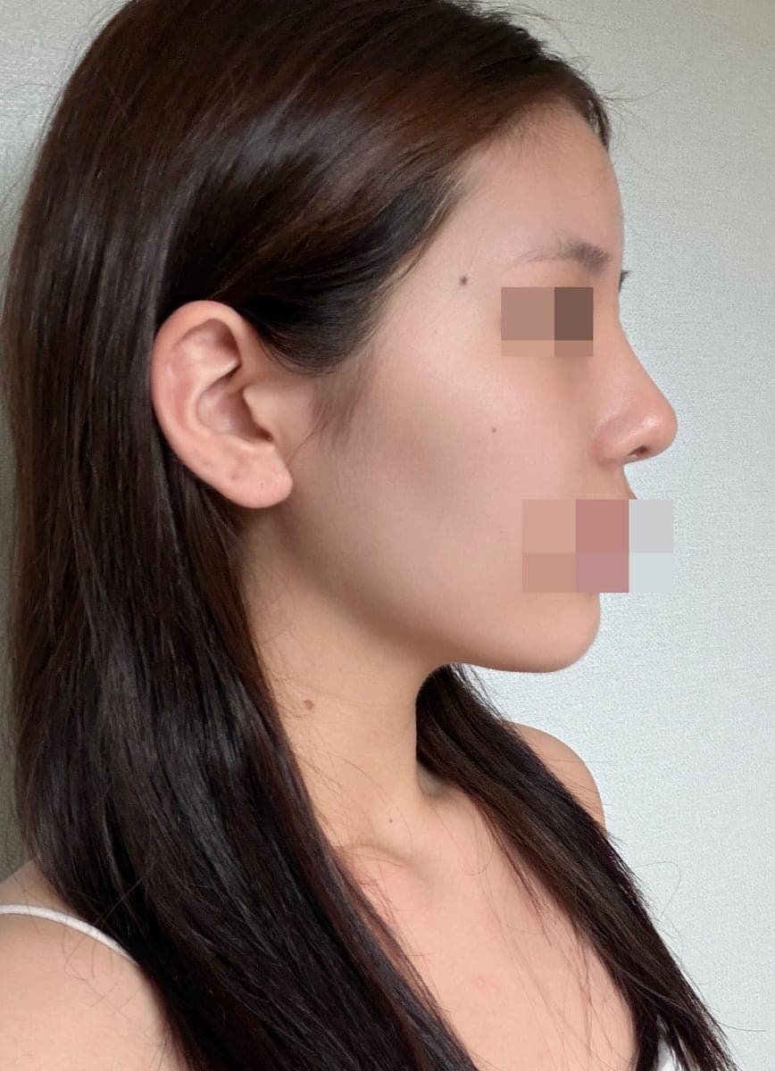 Tip plasty dengan tulang rawan sendiri